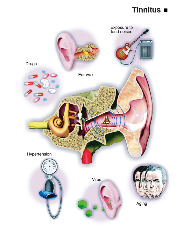 Infografis tinnitus